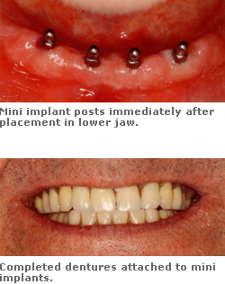 Mini Dental Implant